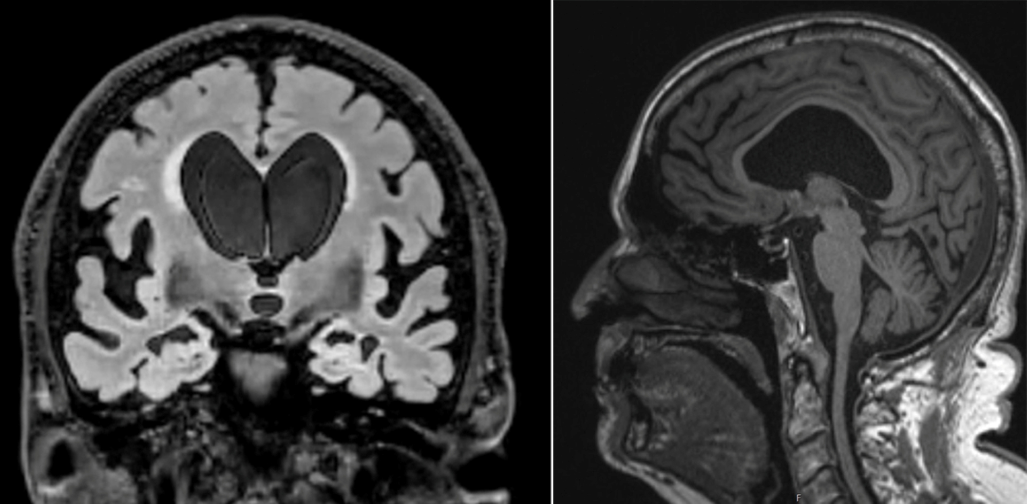 MRI scans from front and side showing brain with symptoms of normal pressure hydrocephalus