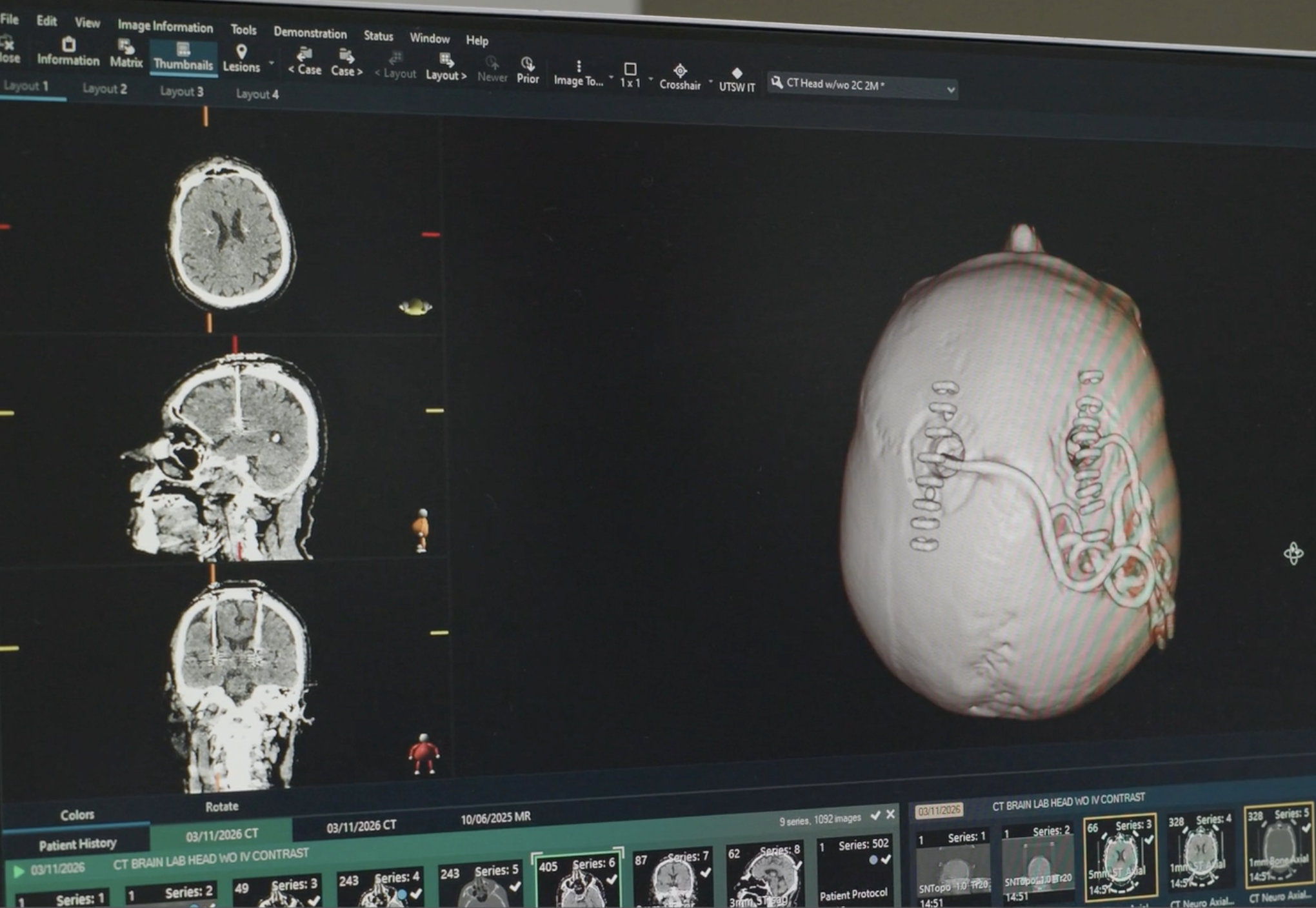 Exploring deep brain stimulation to manage treatment-resistant depression
