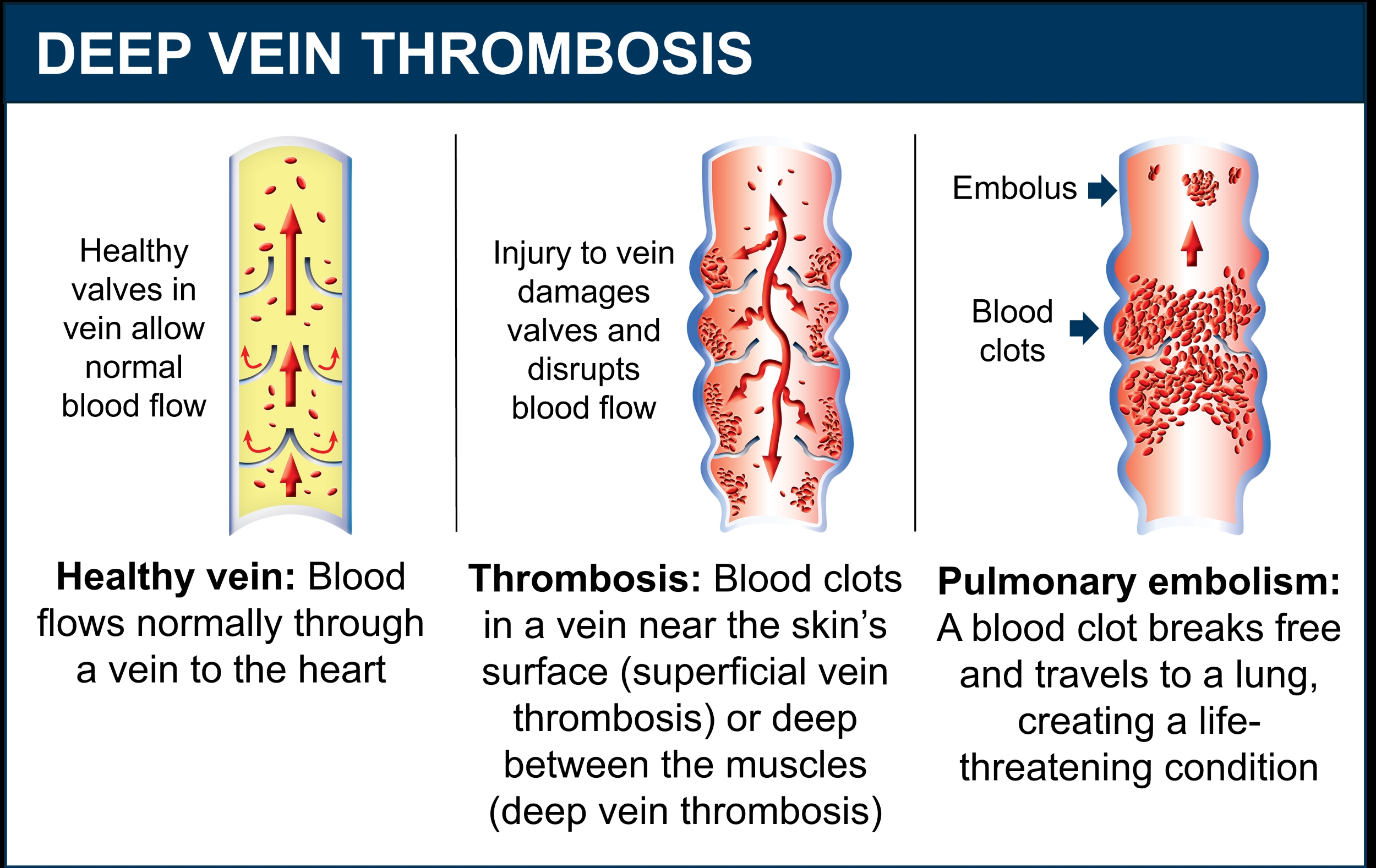 deep vein thrombosis infographic that compares healthy vein to damaged vein with blood clots