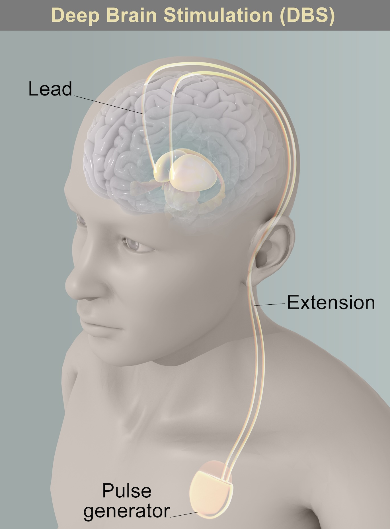 Illustration of patient receiving deep brain stimulation (DBS) therapy with an implanted pulse generator sending current through electrodes into the brain.