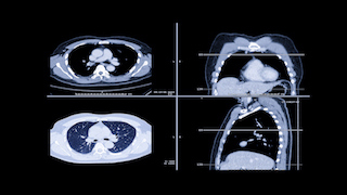 CT scan images of lungs
