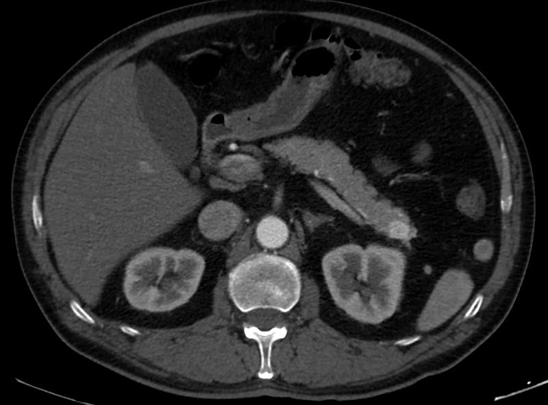 Pancreatic dynamic enhanced spiral CT