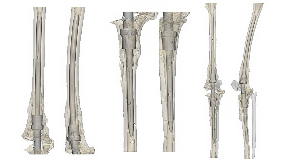 Anterior and lateral views showing how the customized implant would fit in patient's leg with top half of leg, bottom half of leg, and entire leg