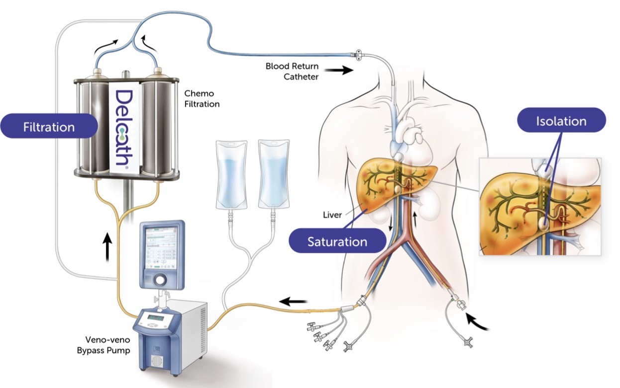 Illustration showing how Hepzato Kit works to treat metastatic uveal melanoma