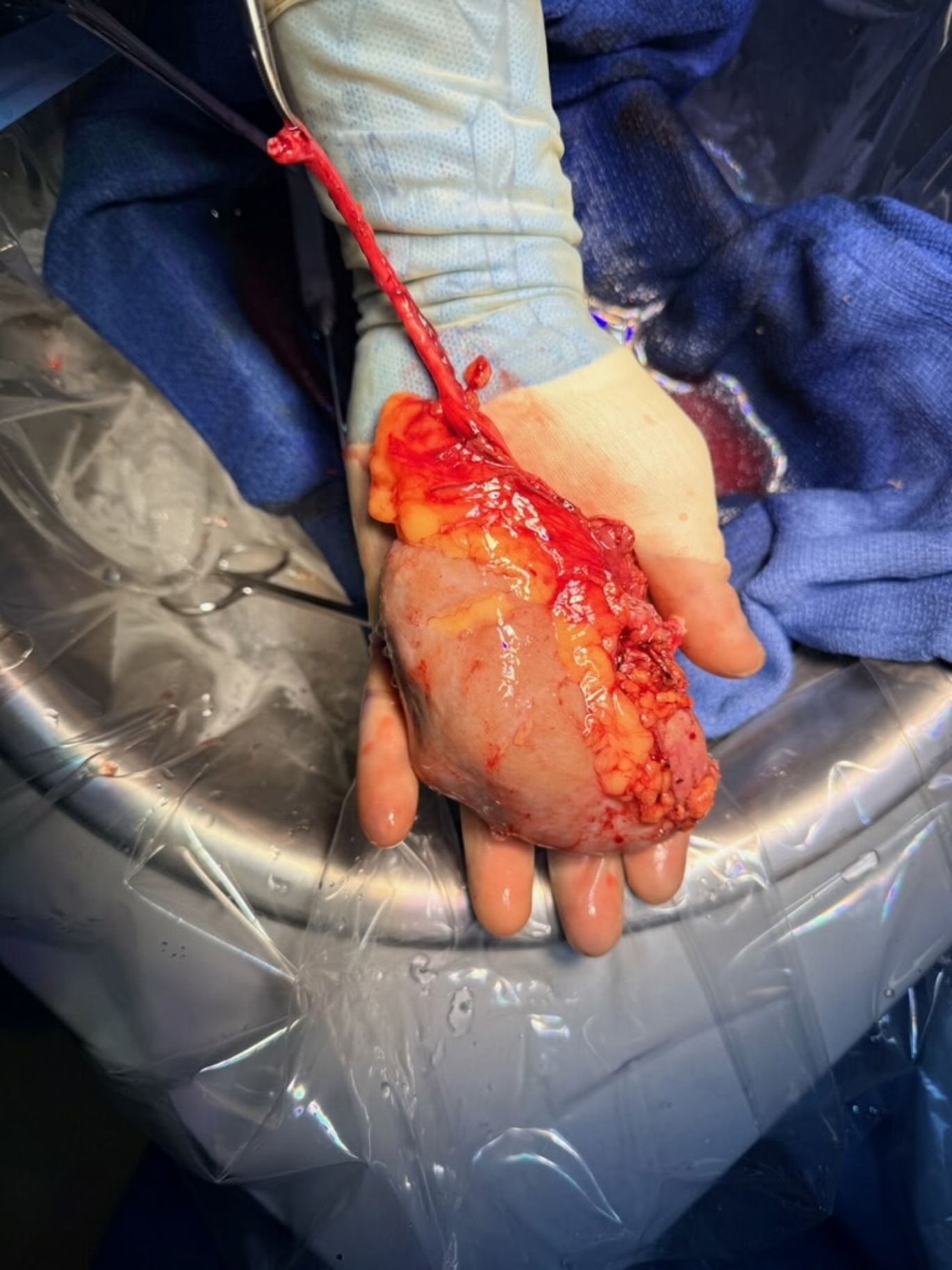 Sheila Campbell's kidney that she donated to RayMond Hamilton.