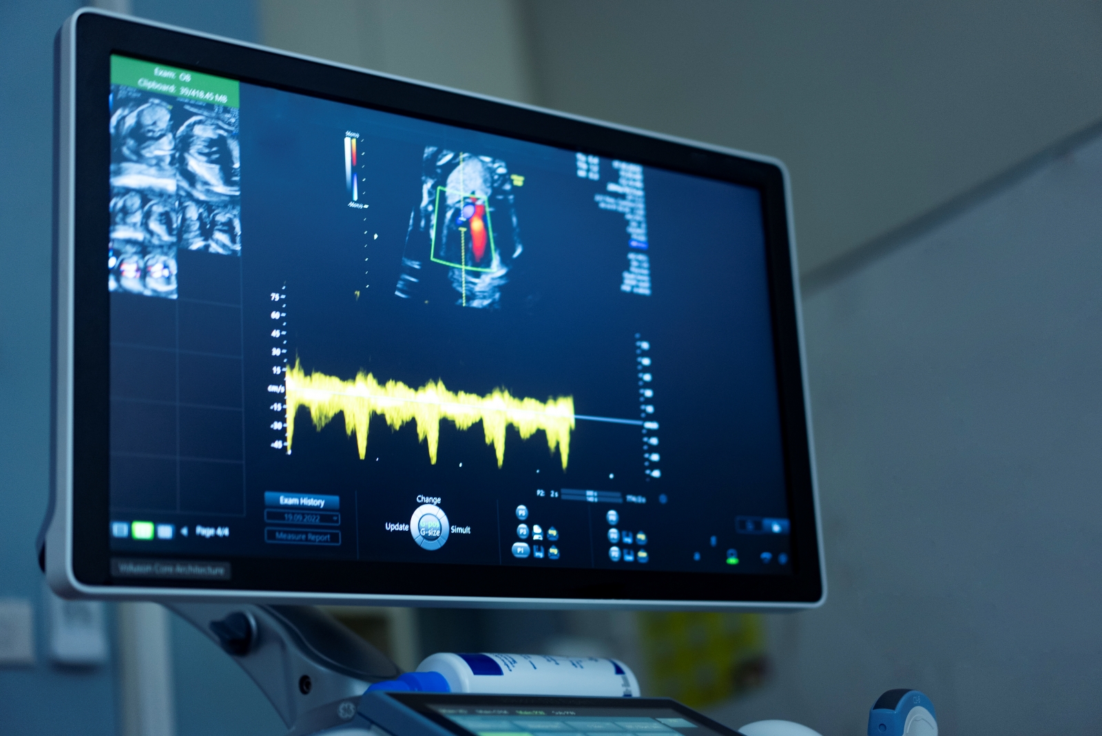 ultrasound sonogram of fetus
