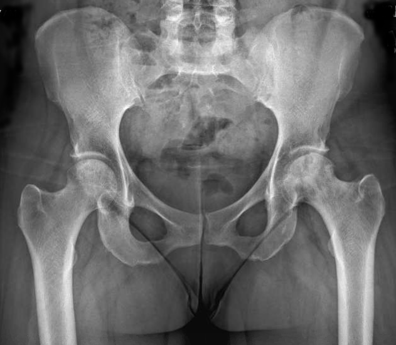Hip x-ray