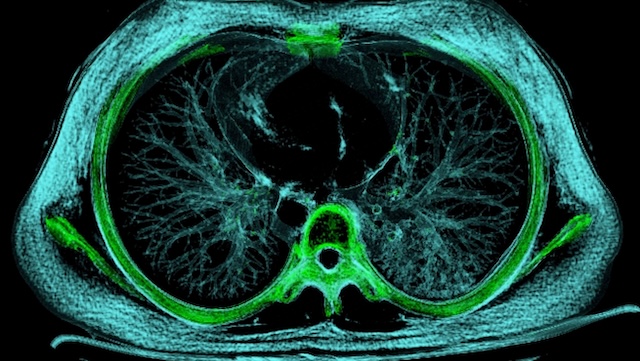 Scan of someone's lungs