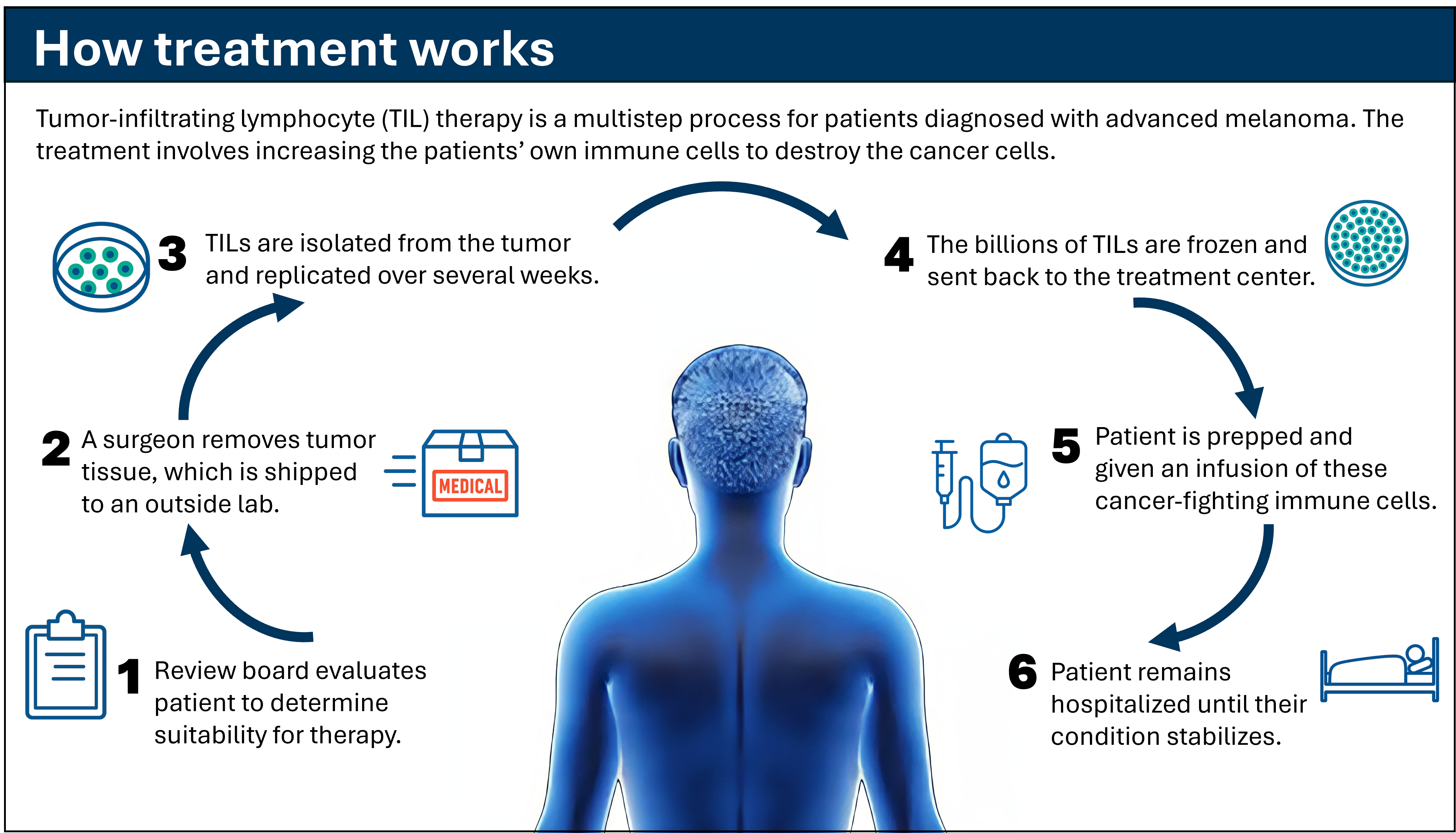 Diagram showing the six‑step process of tumor‑infiltrating lymphocyte (TIL) therapy for advanced melanoma, from patient evaluation through cell infusion and recovery.