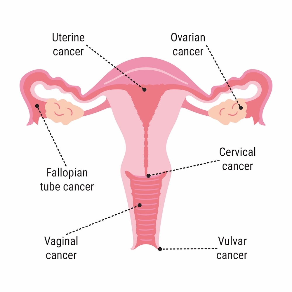 gynecologic cancer diagram