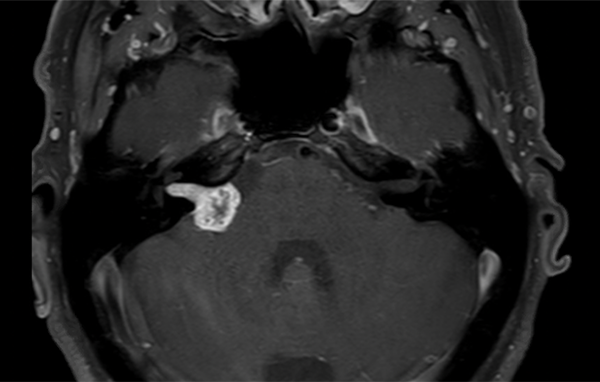 Acoustic Neuroma