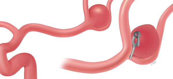 Brain Aneurysm