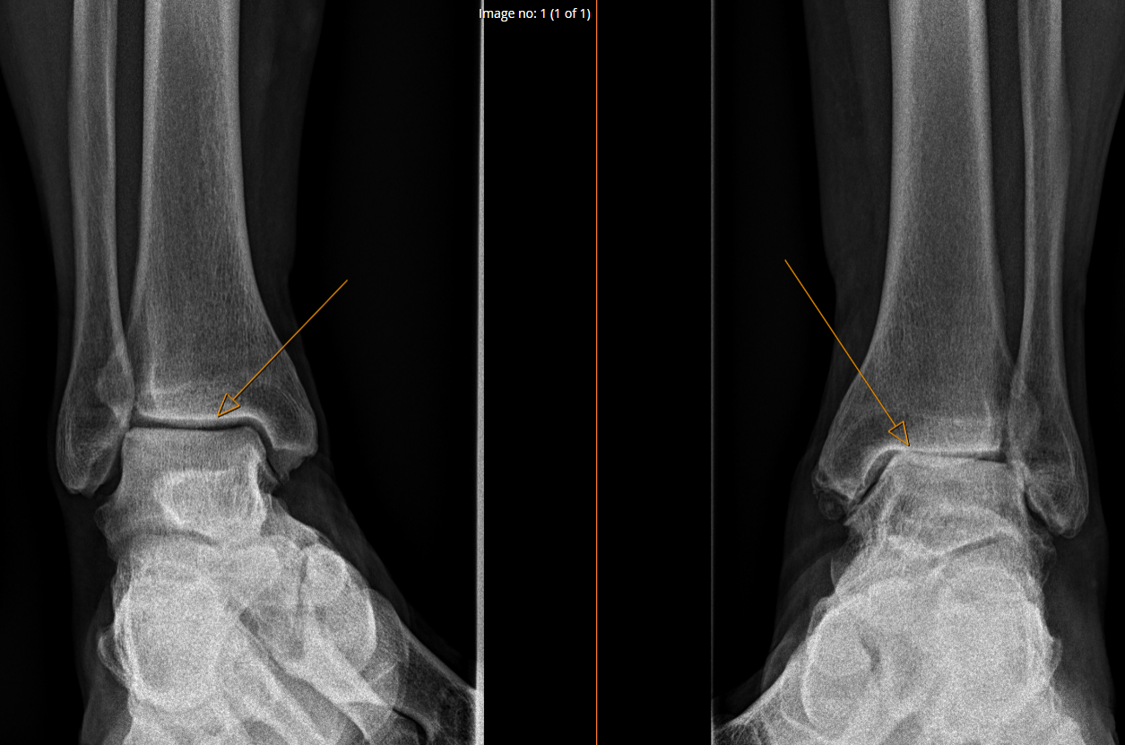 An x-ray of an ankle with arthritis