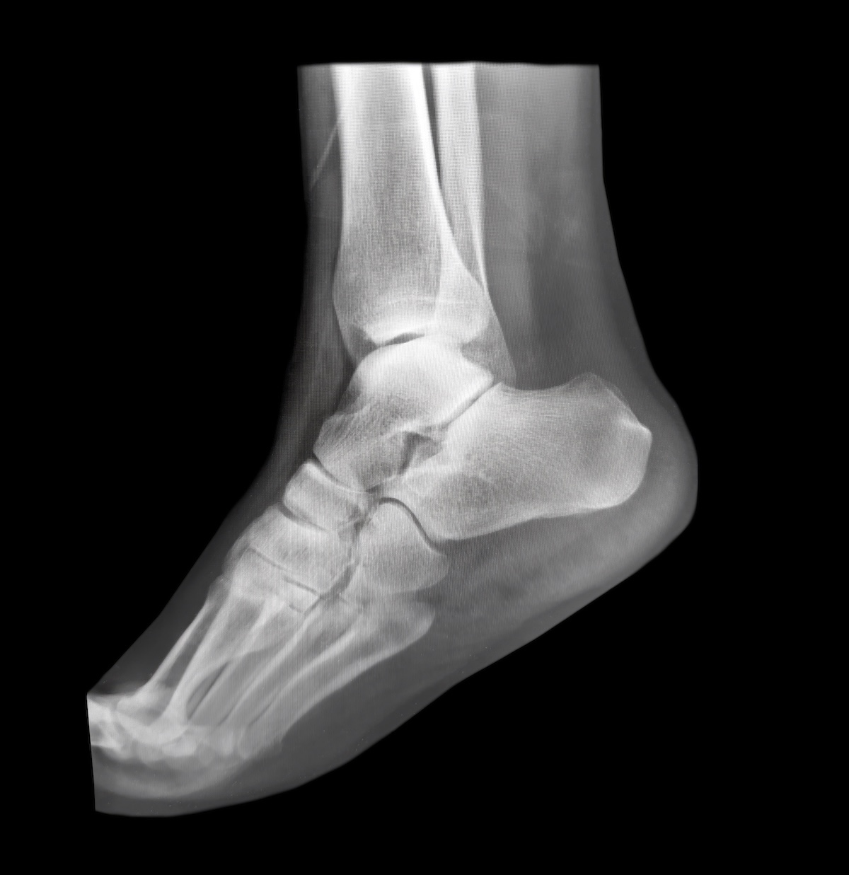 Ankle x-ray