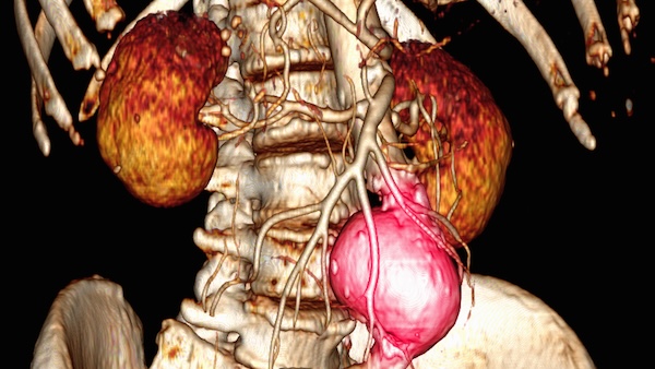 Medical imaging of an abdominal aortic aneurysm