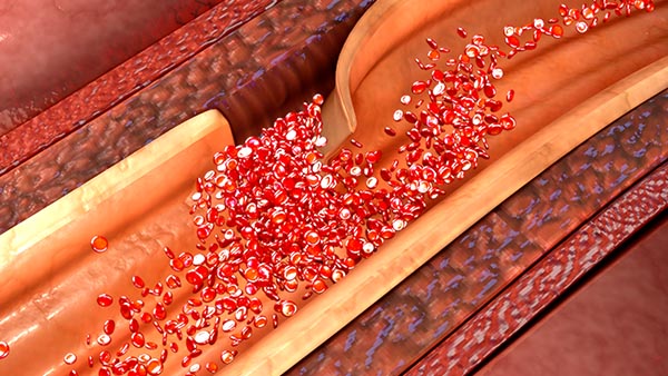 Aortic Dissection