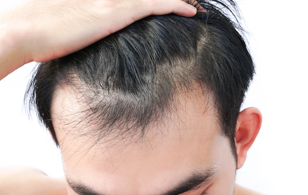 PRP for hair loss: Can it reverse baldness without surgery, pills, or creams? | Plastic Surgery | UT Southwestern Medical Center
