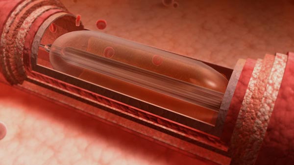 Balloon Angioplasty and Heart Stents