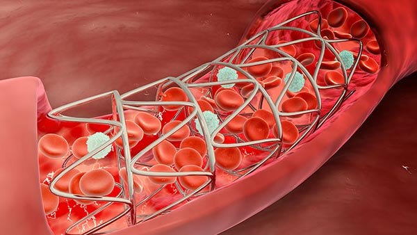 Balloon Valvuloplasty