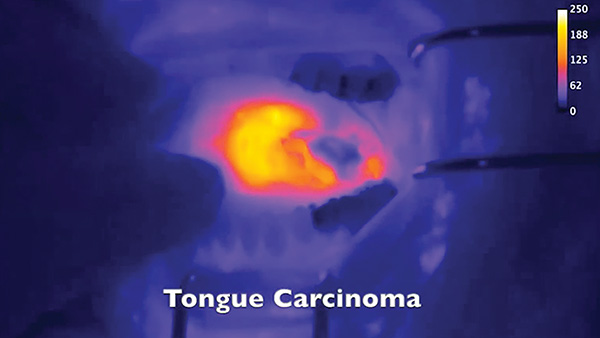 Fluorescent Nanoprobe image of tongue carcinoma