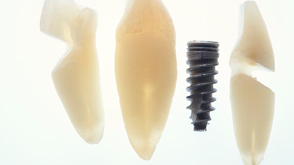 Bone Grafts and Dental Implants