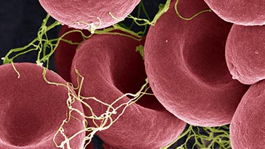Bone Marrow Transplant