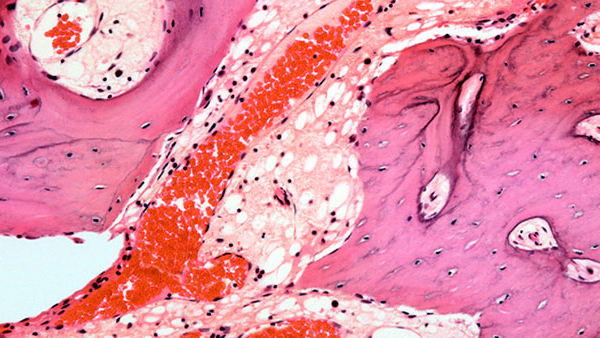 Bone Marrow Transplant (Stem Cell Transplant)