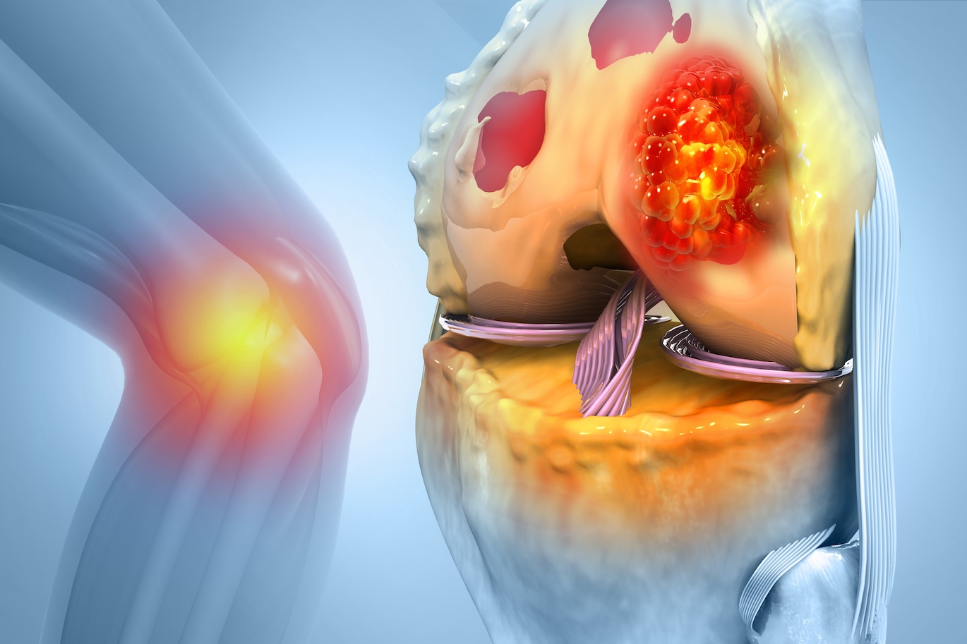 Bone cancer, knee joint, giant cell tumor of bone, osteosarcoma