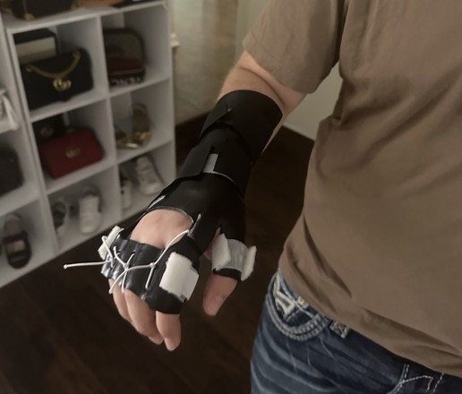 Splint on teen's right hand that assists with hand movement
