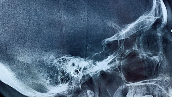 Brain and Spine Trauma