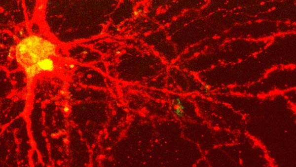 Brain Metastases