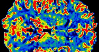 Color-coded brain scan image showing areas of activity