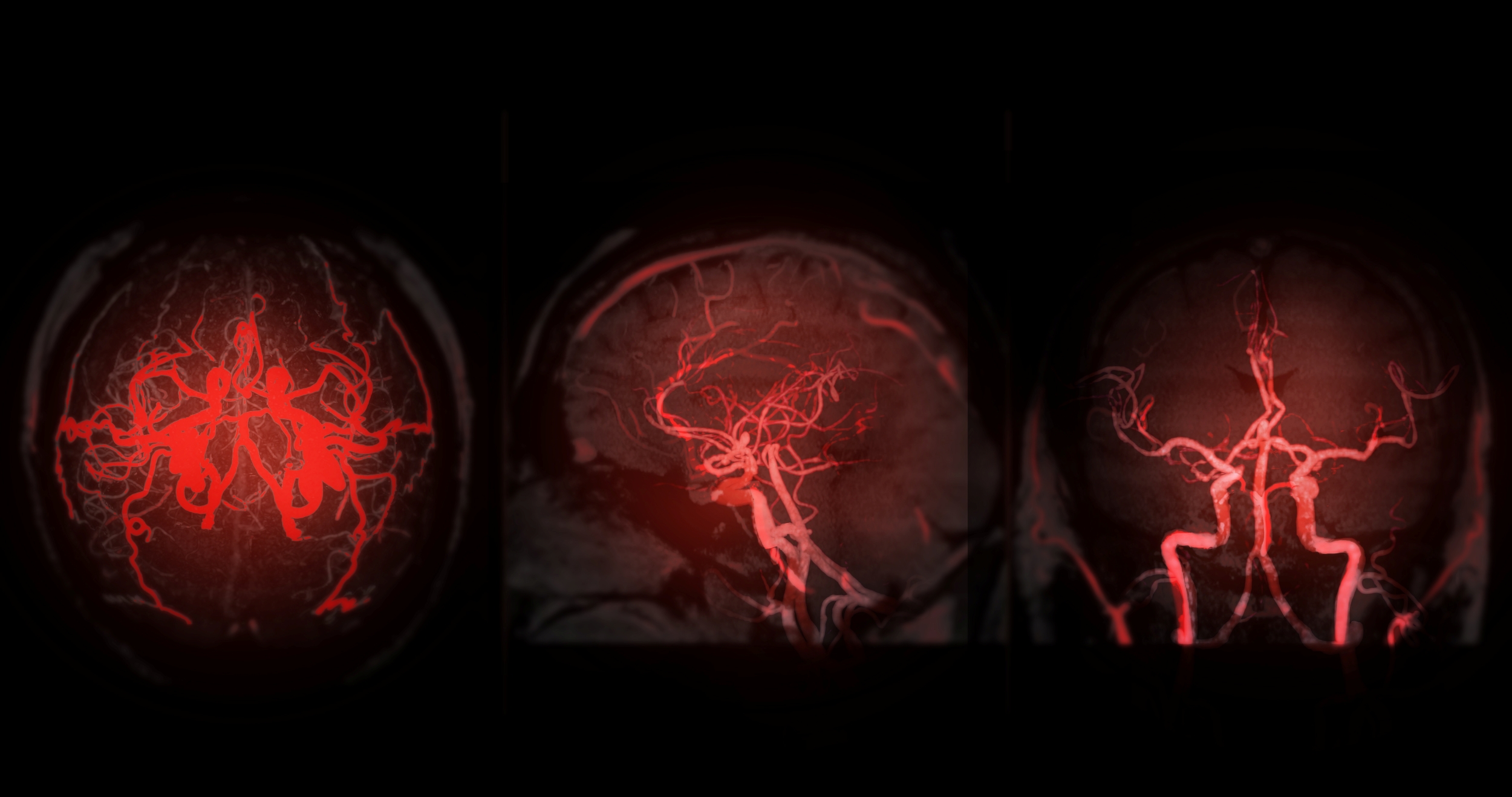 three views from brain angiogram that shows blood vessels in red