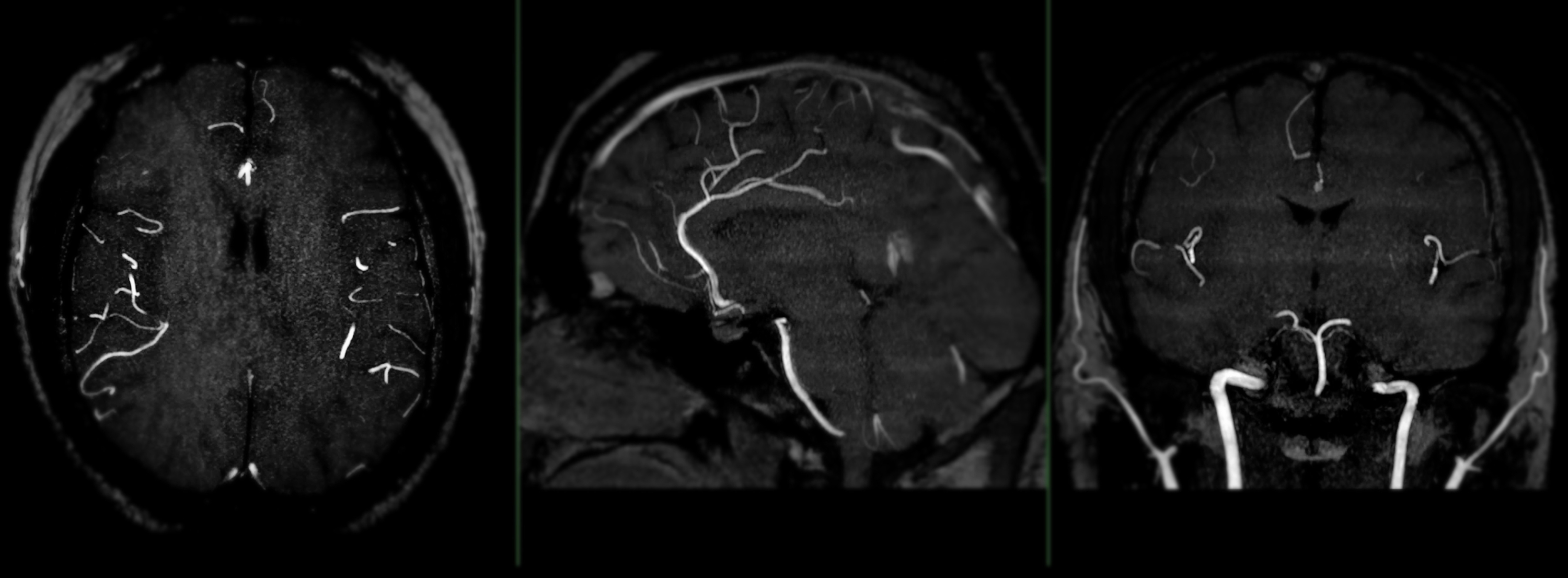three views from brain angiogram that shows blood vessels