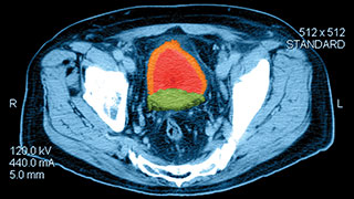 A cross-sectional MRI scan of the pelvic region with the prostate highlighted in red and green, illustrating areas of interest for prostate cancer treatment