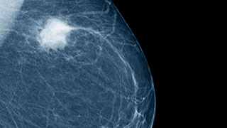 breast tumor