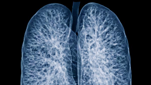 X-ray image of the lungs