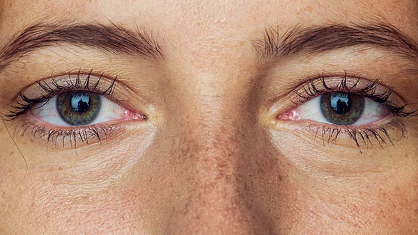 Cornea and External Eye Diseases