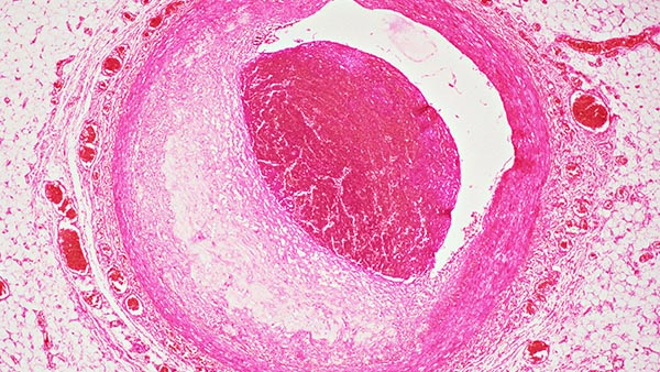Microscopic image showing a cross-section of a coronary artery with plaque buildup