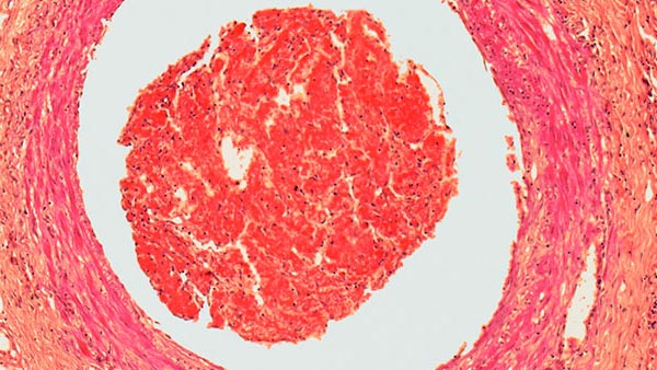 Deep Vein Thrombosis