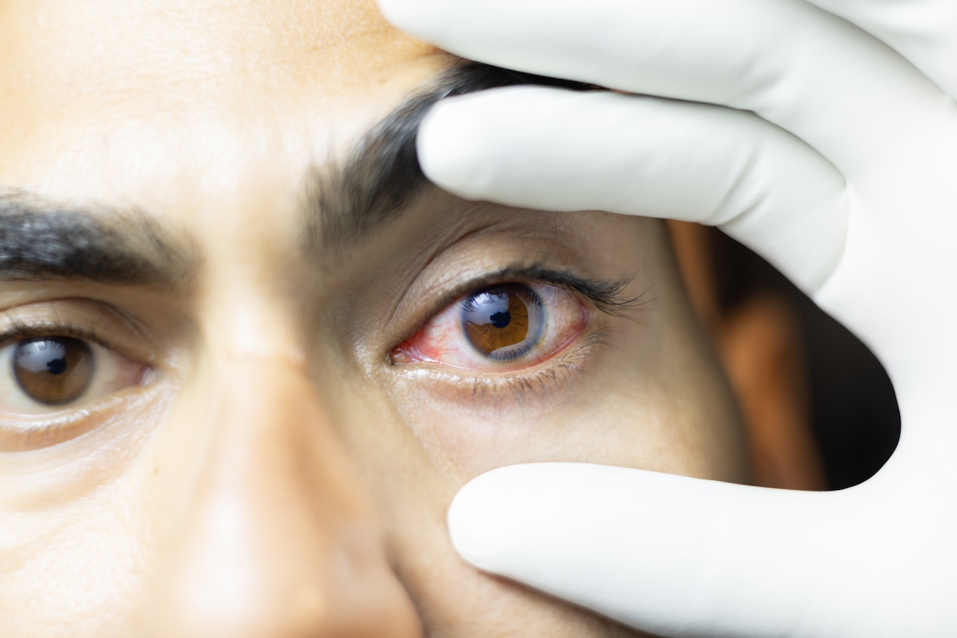 Doctor looking at a persons eye who has redness and irritation