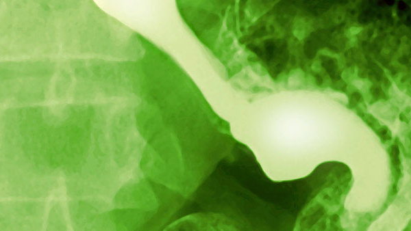 Esophageal Perforation