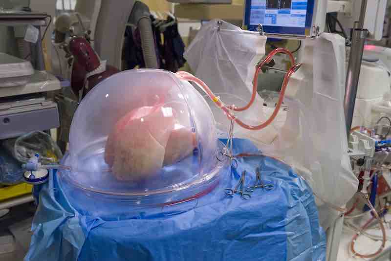 Donor lungs on the ex-vivo lung perfusion pump are perfused through the pulmonary artery cannula and the left atrial cannula. The lungs are inflated via the endotracheal tube connected to a mechanical ventilator.