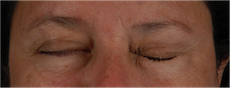 A patient's eyes after treatment.
