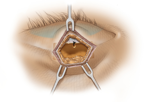 Weight placement and fixation to the levator aponeurosis superior to the tarsal plate, a technique that hides the goldweight.