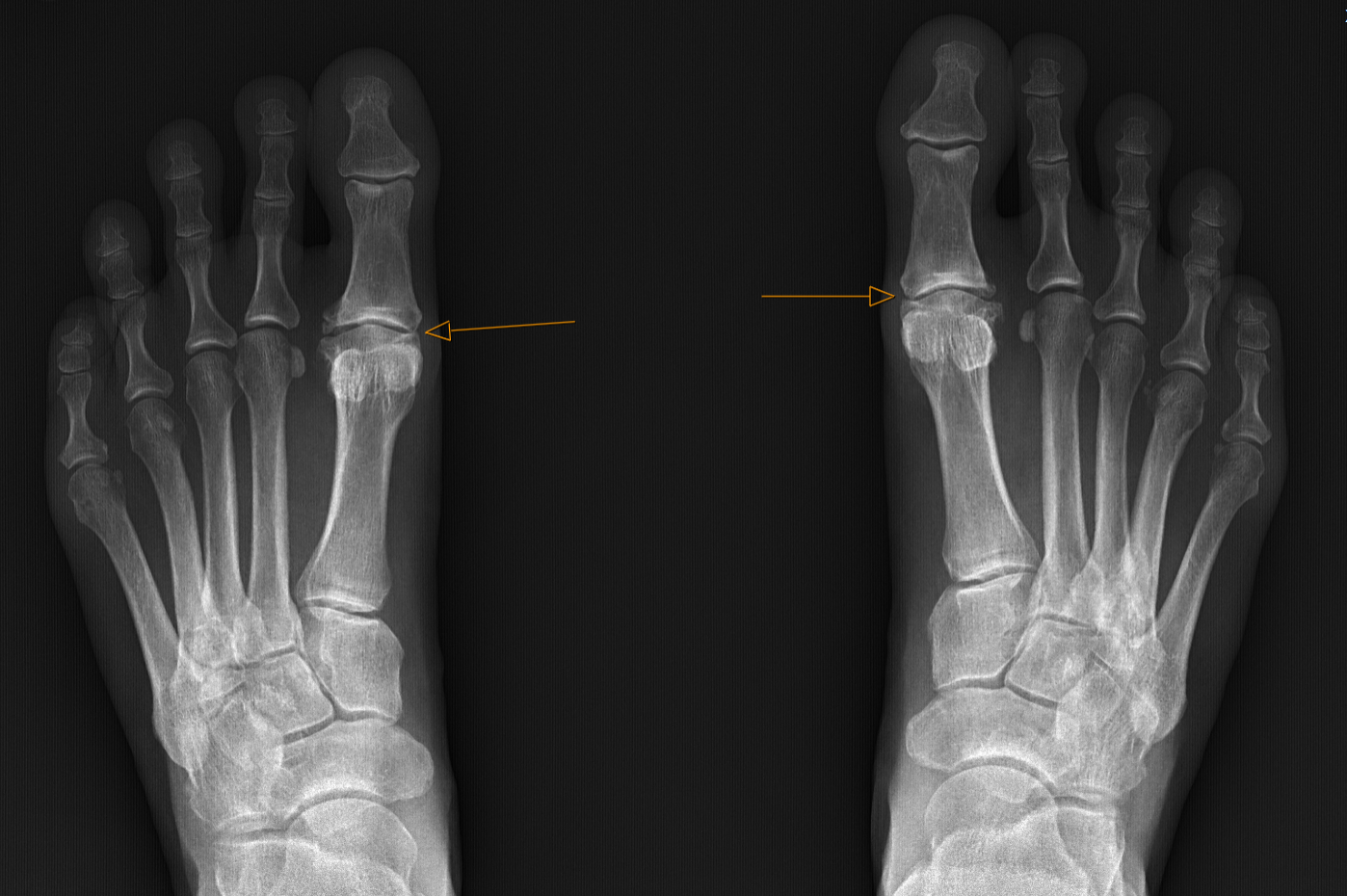 X-ray of feet