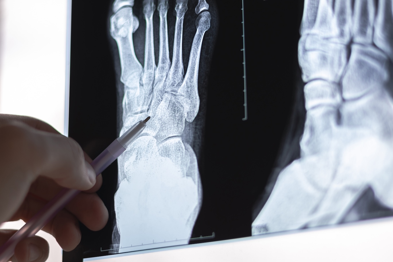 Hand pointing at a foot and ankle x-ray
