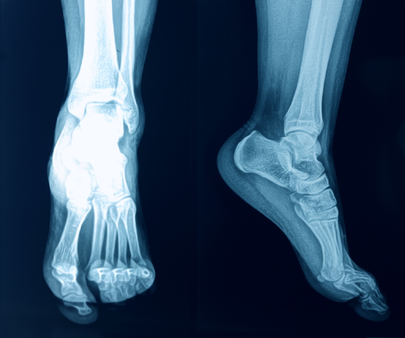 X-rays of feet