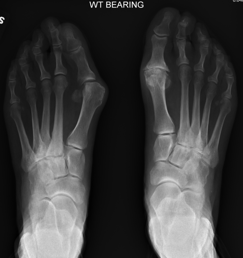X-ray of feet