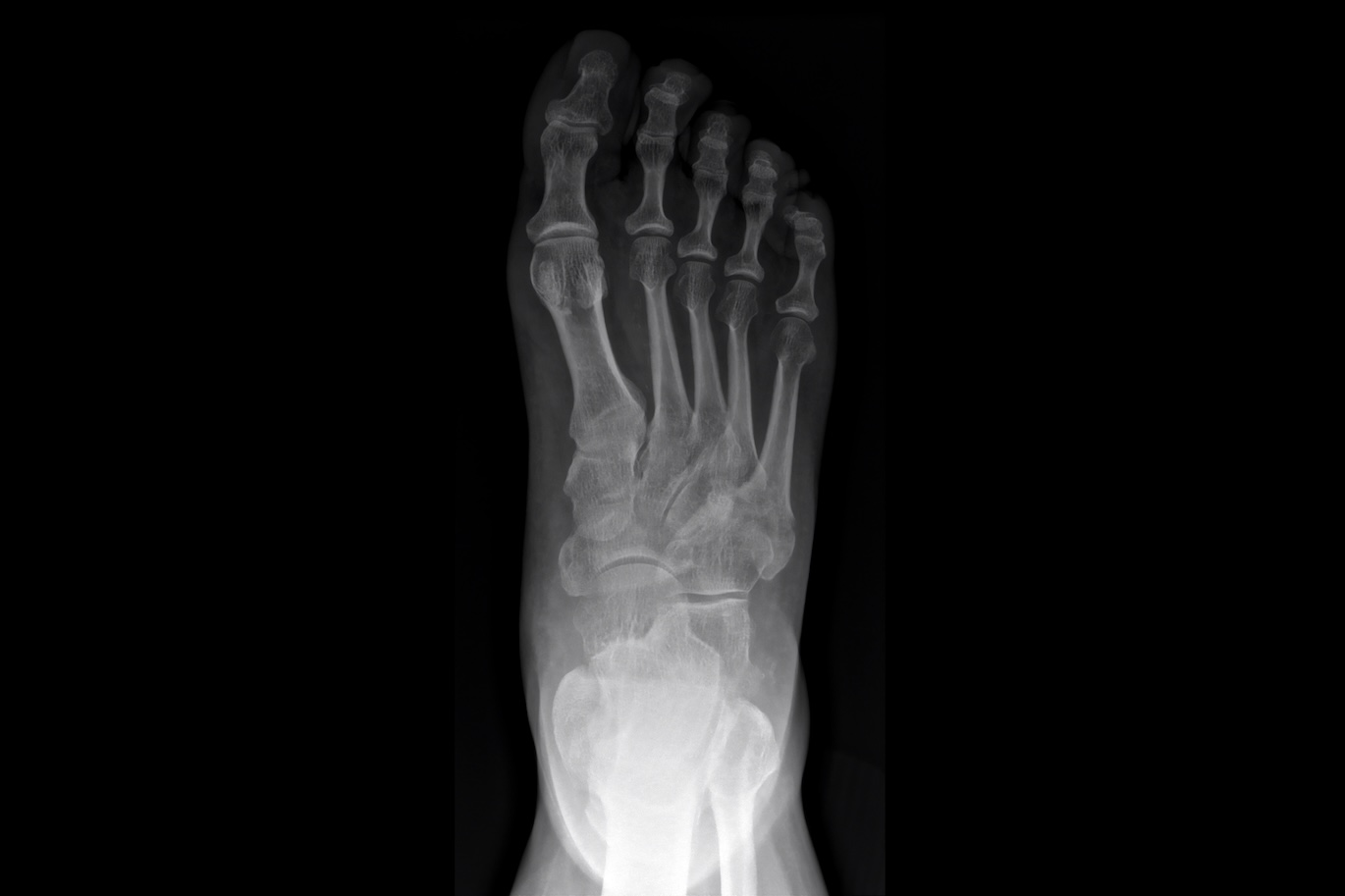 Xray image of human feet showing bones, joints, toes and skeletal structure